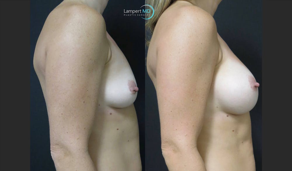 Breast Augmentation Before & After Gallery - Patient 122908740 - Image 6