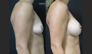 Breast Augmentation Before & After Gallery - Patient 122908740 - Image 6