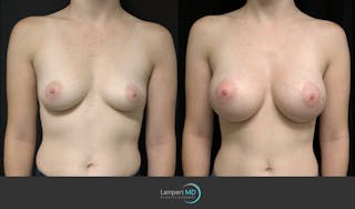 Breast Augmentation Before & After Gallery - Patient 122908744 - Image 1