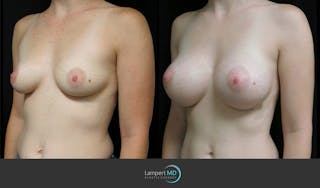 Breast Augmentation Before & After Gallery - Patient 122908744 - Image 2