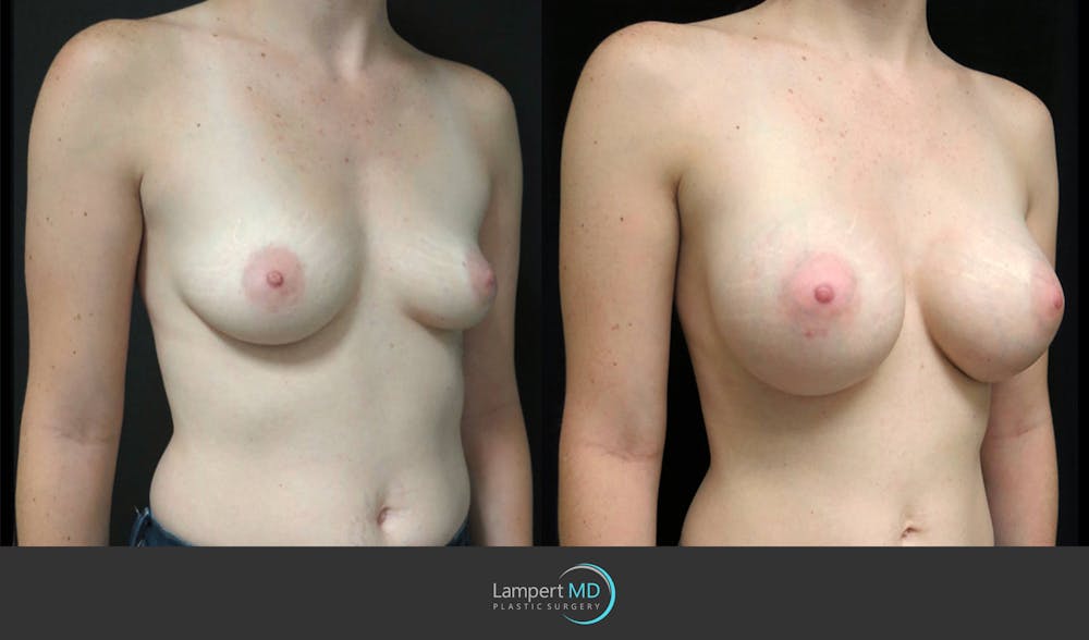 Breast Augmentation Before & After Gallery - Patient 122908744 - Image 3