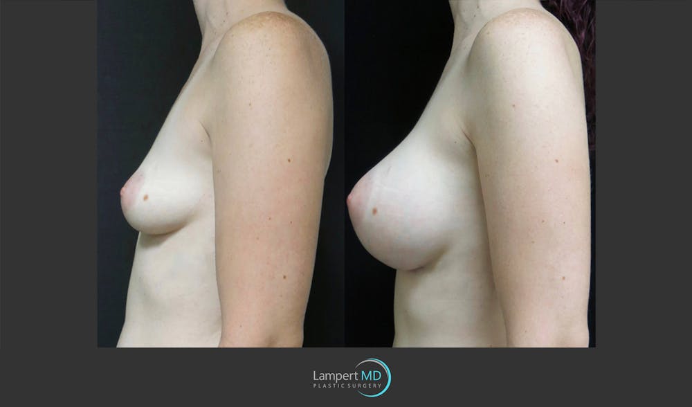 Breast Augmentation Before & After Gallery - Patient 122908744 - Image 4
