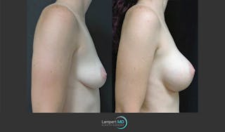 Breast Augmentation Before & After Gallery - Patient 122908744 - Image 5