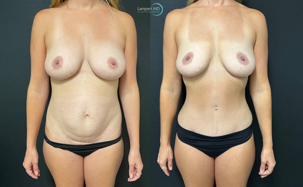 Mommy Makeover Before & After Gallery - Patient 143556266 - Image 1