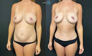 Tummy Tuck Before & After Gallery - Patient 142815678 - Image 2
