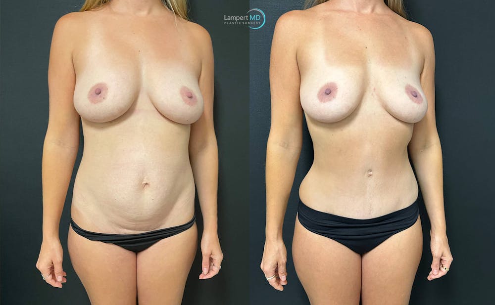 Tummy Tuck Before & After Gallery - Patient 142815678 - Image 3