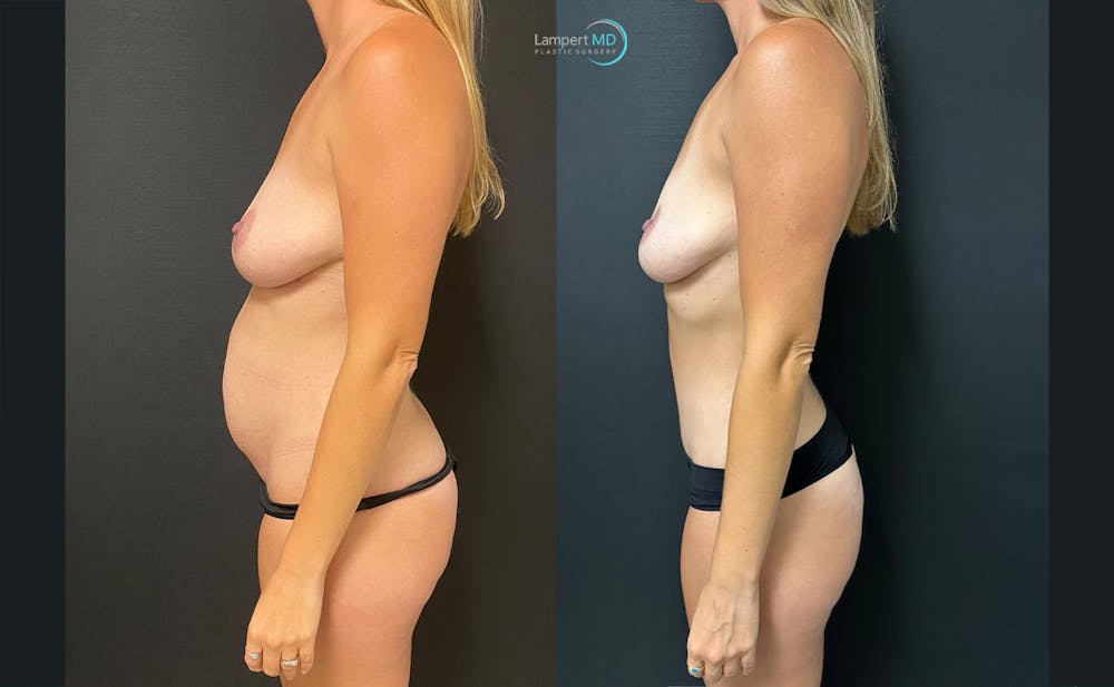 Tummy Tuck Before & After Gallery - Patient 142815678 - Image 4