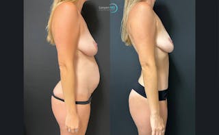 Tummy Tuck Before & After Gallery - Patient 142815678 - Image 5