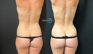 Tummy Tuck Before & After Gallery - Patient 142815678 - Image 6