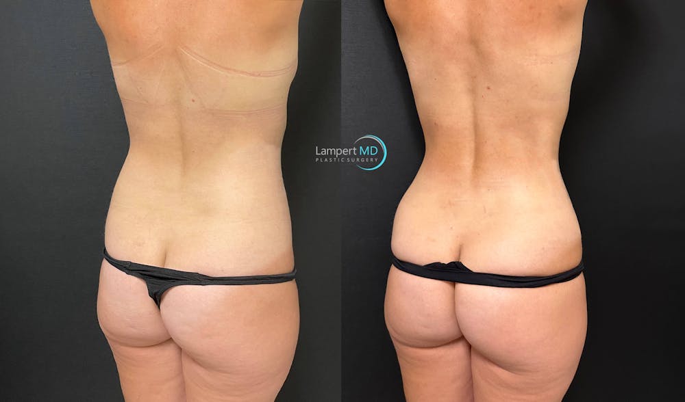 Tummy Tuck Before & After Gallery - Patient 142815678 - Image 7