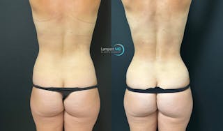 Tummy Tuck Before & After Gallery - Patient 142815678 - Image 8