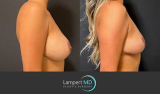 Breast Explant Before & After Gallery - Patient 148520606 - Image 5