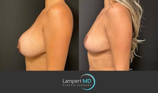 Breast Explant Before & After Gallery - Patient 148520606 - Image 4