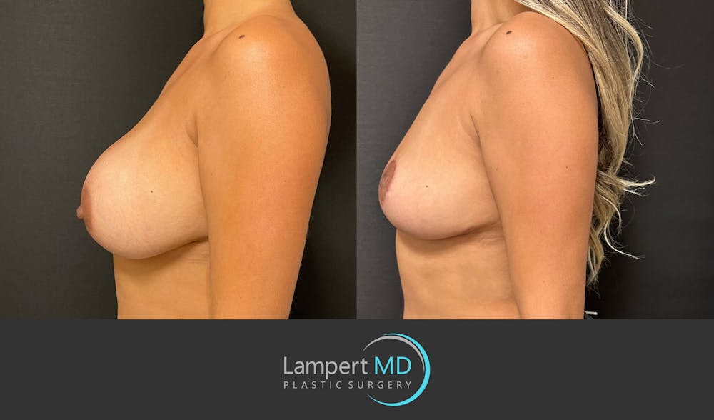 Breast Explant Before & After Gallery - Patient 148520606 - Image 4