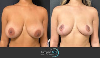 Breast Explant Before & After Gallery - Patient 148520606 - Image 1