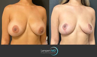 Breast Explant Before & After Gallery - Patient 148520606 - Image 3