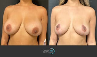 Breast Explant Before & After Gallery - Patient 148520606 - Image 2