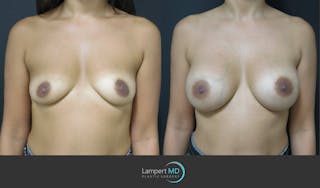 Breast Augmentation Before & After Gallery - Patient 122908736 - Image 1