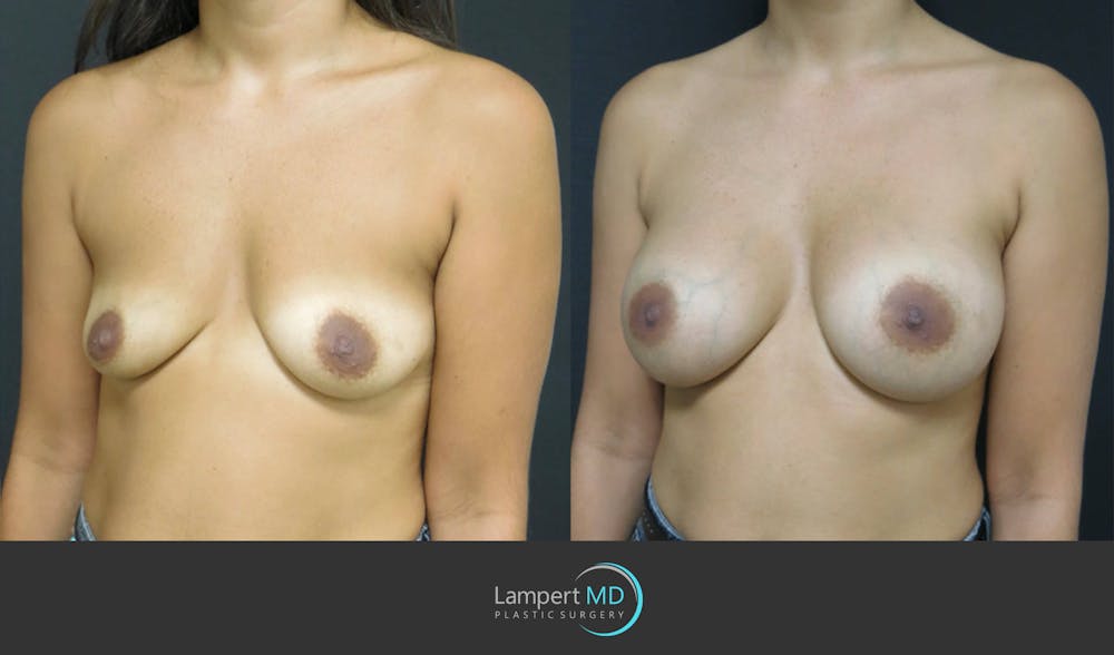 Breast Augmentation Before & After Gallery - Patient 122908736 - Image 2