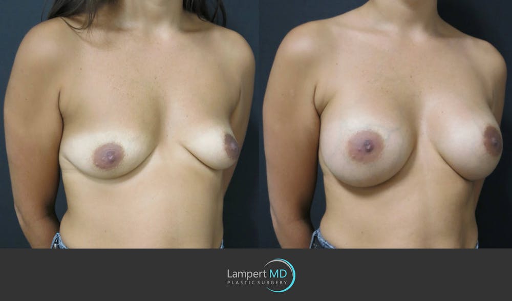 Breast Augmentation Before & After Gallery - Patient 122908736 - Image 3