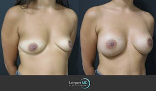 Breast Augmentation Before & After Gallery - Patient 122908736 - Image 3
