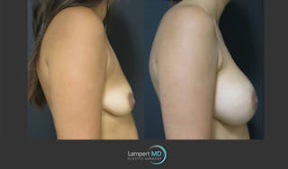 Breast Augmentation Before & After Gallery - Patient 122908736 - Image 4