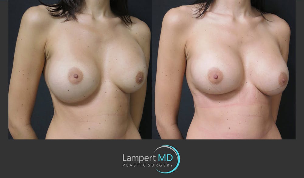 Breast Augmentation Before & After Gallery - Patient 122908771 - Image 2