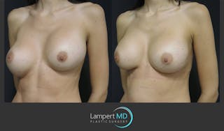 Breast Augmentation Before & After Gallery - Patient 122908771 - Image 3