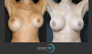 Breast Augmentation Before & After Gallery - Patient 122908771 - Image 4