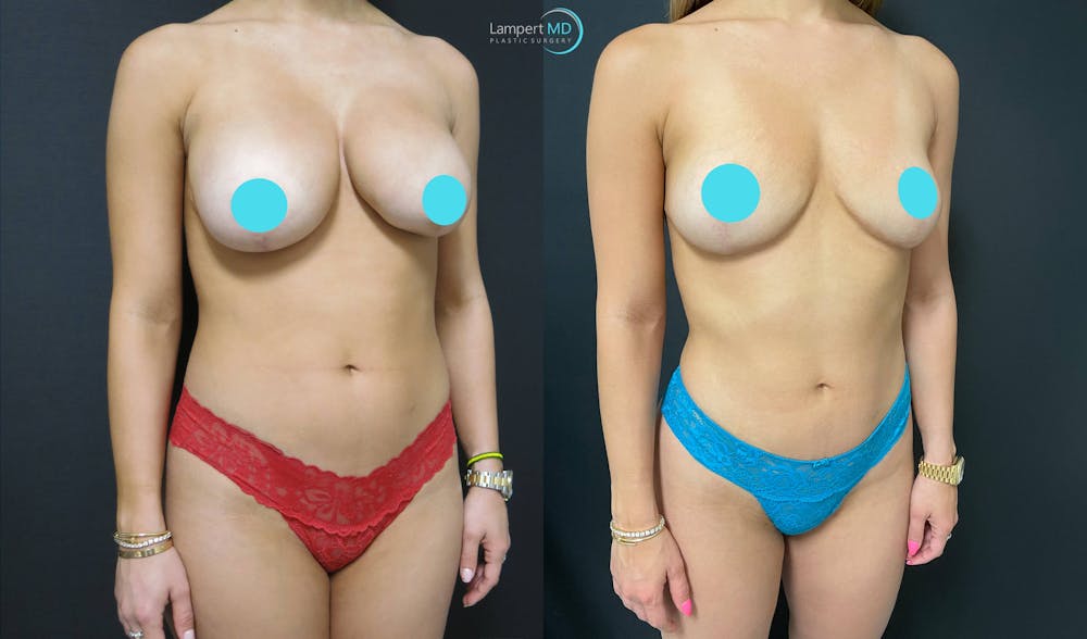 Breast Explant Before & After Gallery - Patient 151885254 - Image 2
