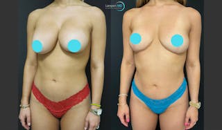 Breast Explant Before & After Gallery - Patient 151885254 - Image 3