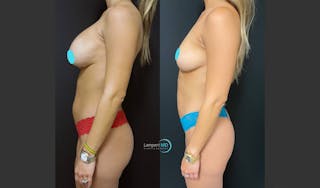 Breast Explant Before & After Gallery - Patient 151885254 - Image 4