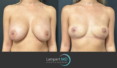 Breast Explant Before & After Gallery - Patient 148735012 - Image 1