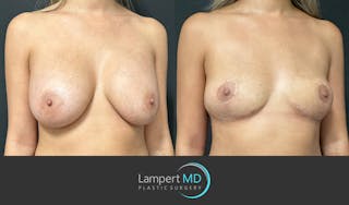 Breast Explant Before & After Gallery - Patient 148735012 - Image 2
