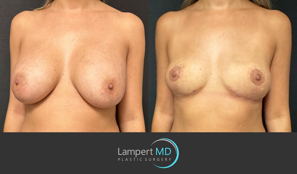 Breast Explant Before & After Gallery - Patient 148735012 - Image 3