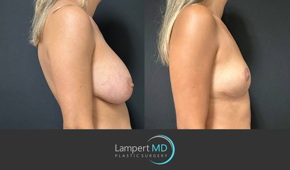 Breast Explant Before & After Gallery - Patient 148735012 - Image 4