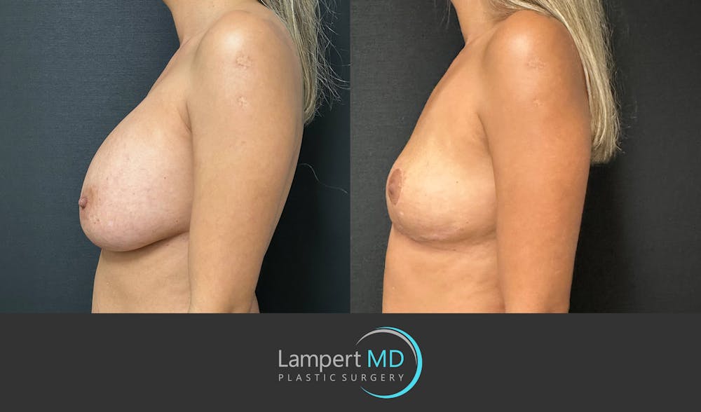 Breast Explant Before & After Gallery - Patient 148735012 - Image 5