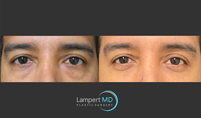 Eyelid Surgery Before & After Gallery - Patient 162336457 - Image 1