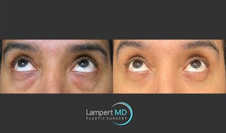 Eyelid Surgery Before & After Gallery - Patient 162336457 - Image 2