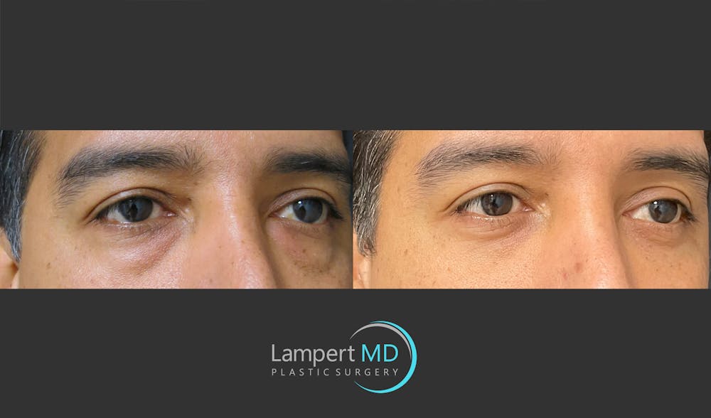 Eyelid Surgery Before & After Gallery - Patient 162336457 - Image 3