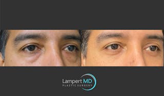 Eyelid Surgery Before & After Gallery - Patient 162336457 - Image 3