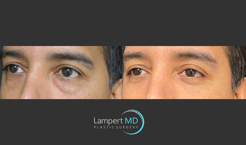 Eyelid Surgery Before & After Gallery - Patient 162336457 - Image 4