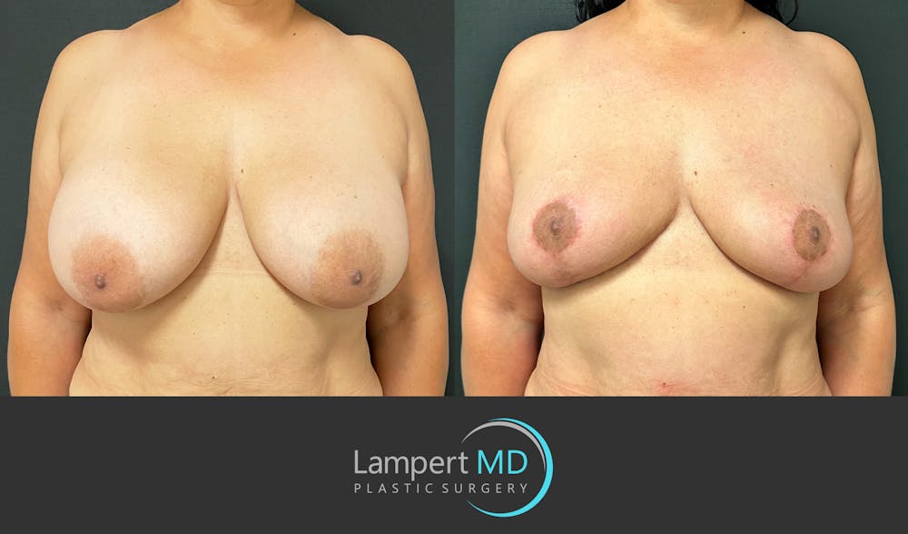 Breast Explant Before & After Gallery - Patient 184643414 - Image 1