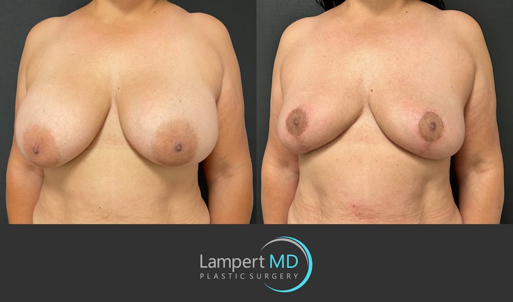 Breast Explant Before & After Gallery - Patient 184643414 - Image 2