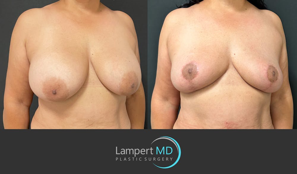 Breast Explant Before & After Gallery - Patient 184643414 - Image 3
