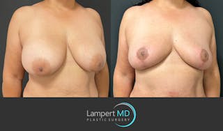 Breast Explant Before & After Gallery - Patient 184643414 - Image 3
