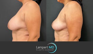 Breast Explant Before & After Gallery - Patient 184643414 - Image 4
