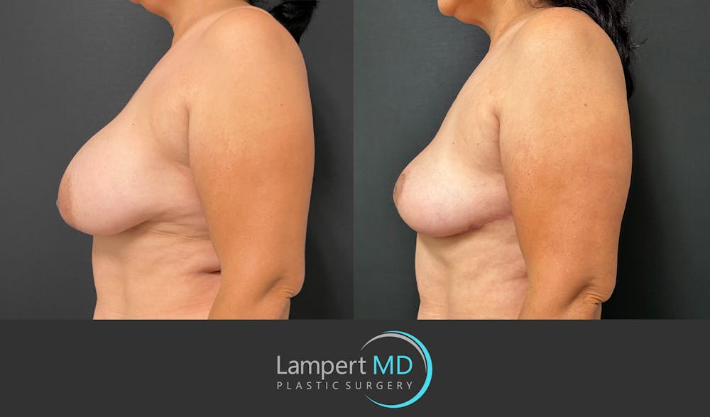 Breast Explant Before & After Gallery - Patient 184643414 - Image 4