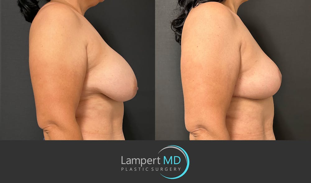 Breast Explant Before & After Gallery - Patient 184643414 - Image 5