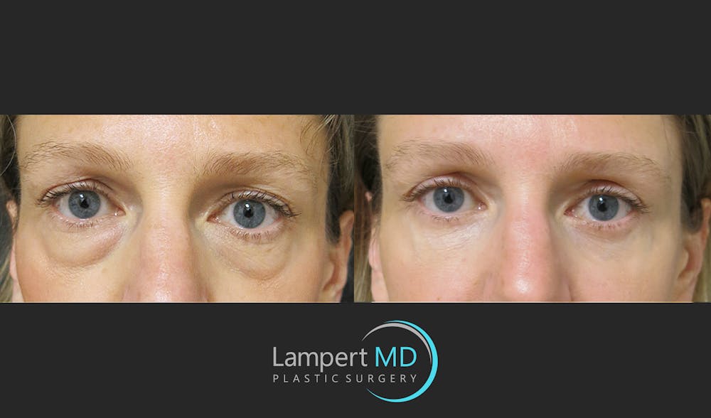 Eyelid Surgery Before & After Gallery - Patient 165636364 - Image 1